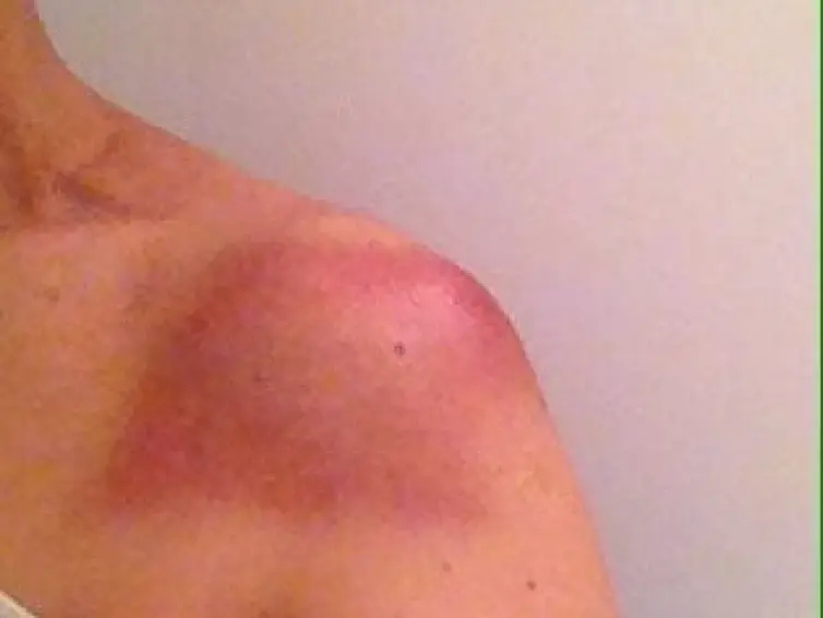 Radiotherapy scarring on Jo's shoulder.