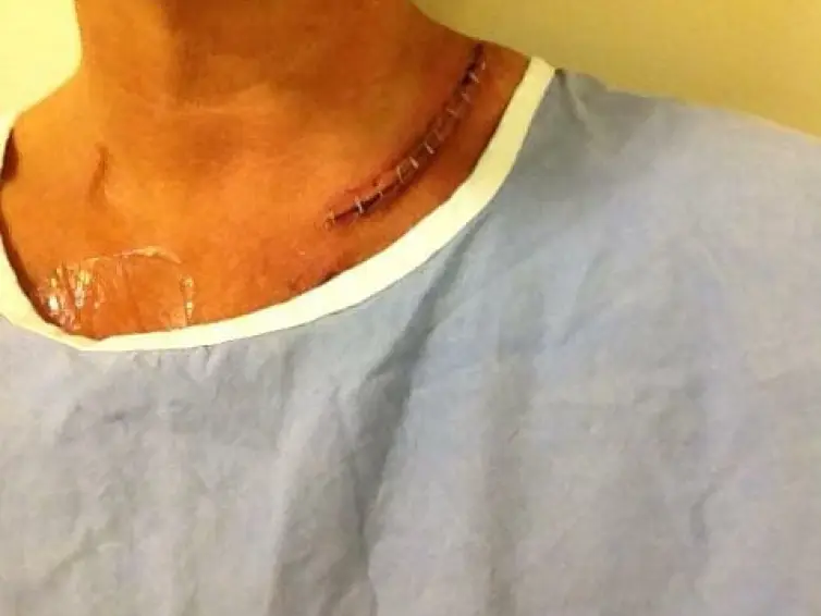 Image of Jo Taylor's neck following surgery.